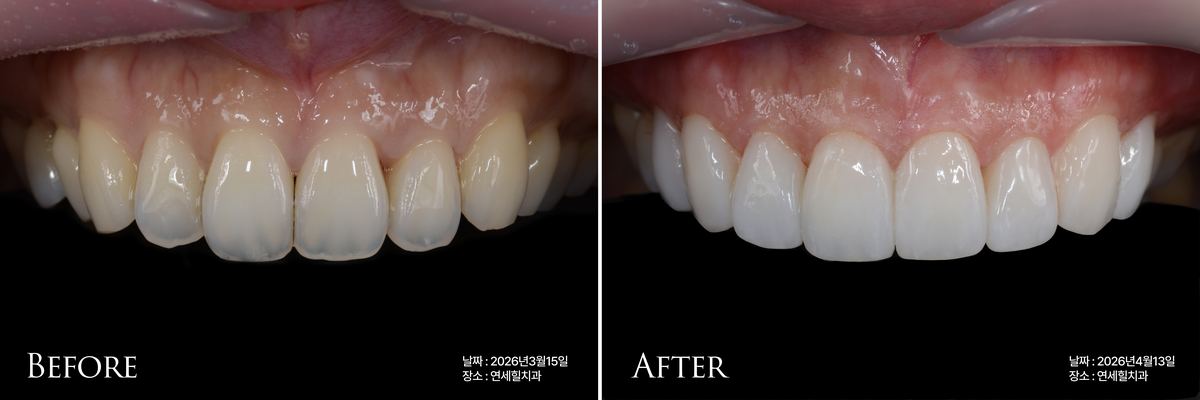 Veneer Case 2