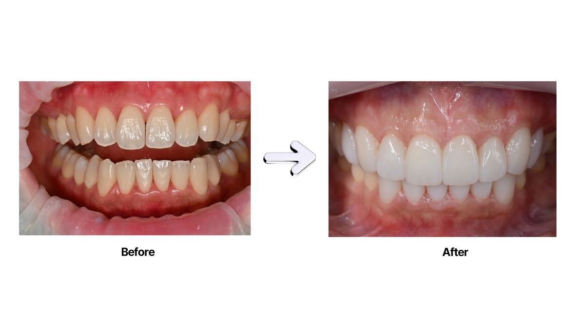 Veneer Case 1