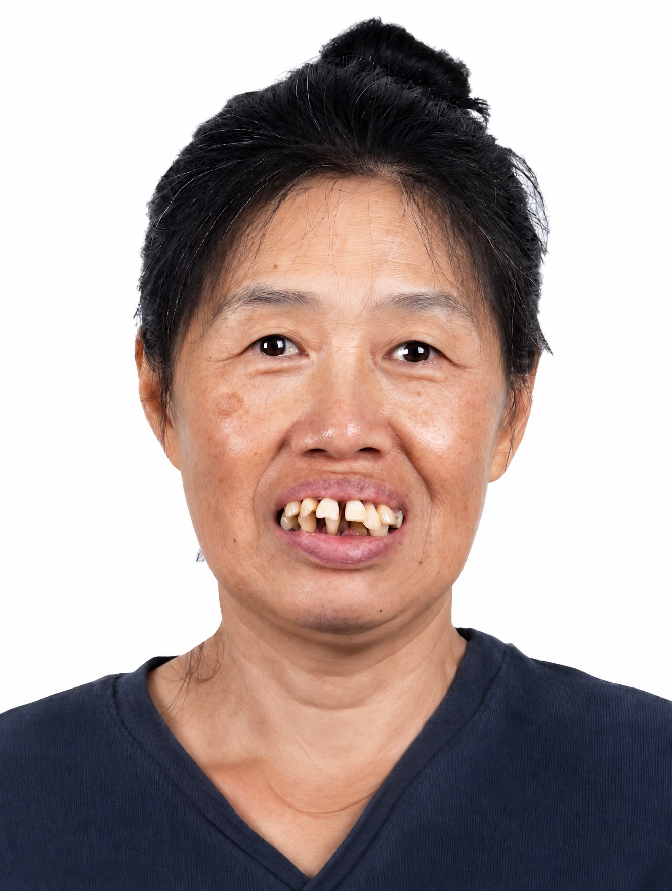 Patient before full arch restoration at Heal Dental Seoul
