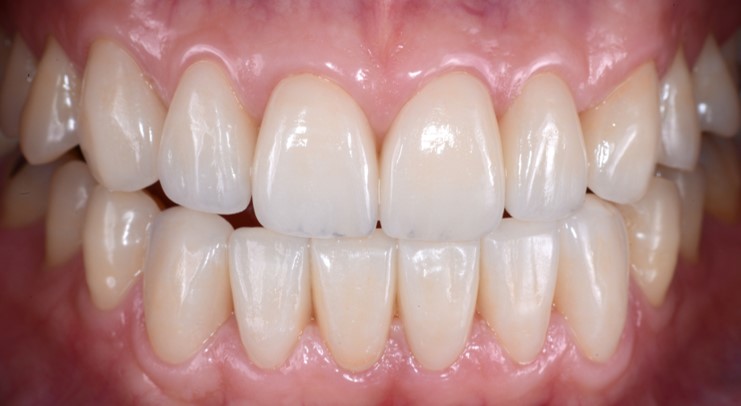 Veneer Case 1 — After