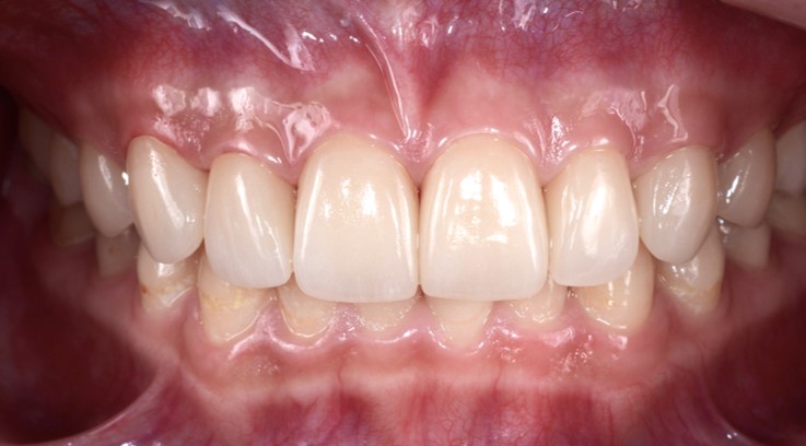 Veneer Case 3 — After