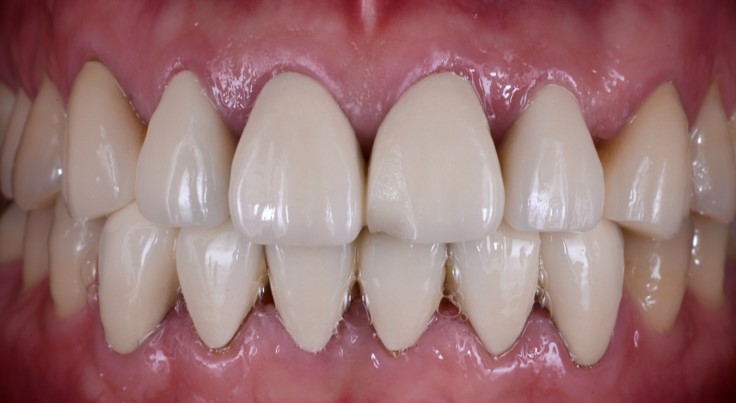 Veneer Case 1 — Before