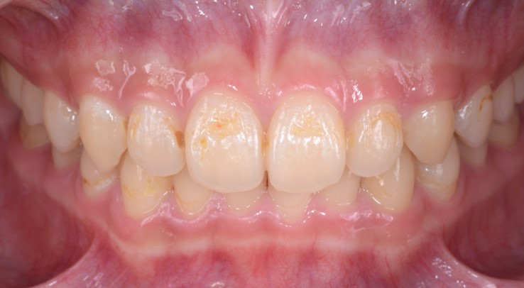 Veneer Case 3 — Before