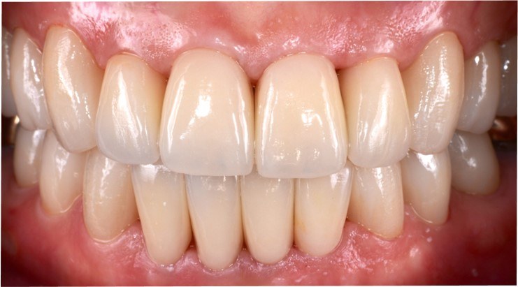 Porcelain veneers before and after — Heal Dental Hospital Seoul