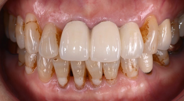 Discolored and worn dentition before full anterior restoration — Heal Dental Hospital Seoul