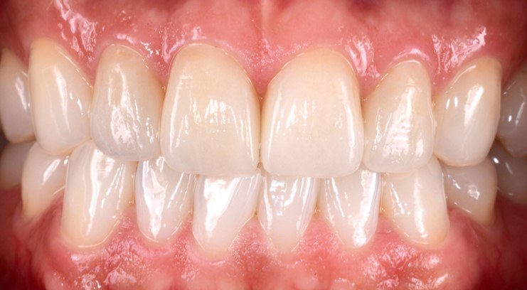 Laminate veneers with natural translucency — Heal Dental Hospital Seoul