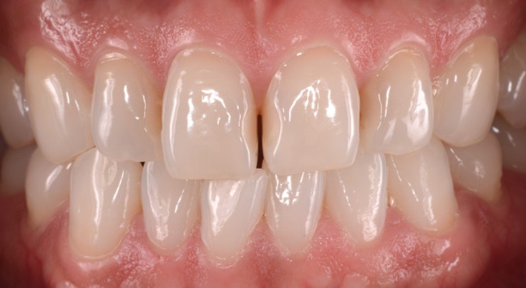 Anterior teeth before laminate veneers — Heal Dental Hospital Seoul